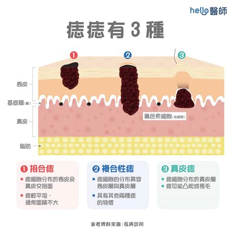 痣 顏色|痣形成的原因？痣長毛、痣變多變大是痣病變？5招判。